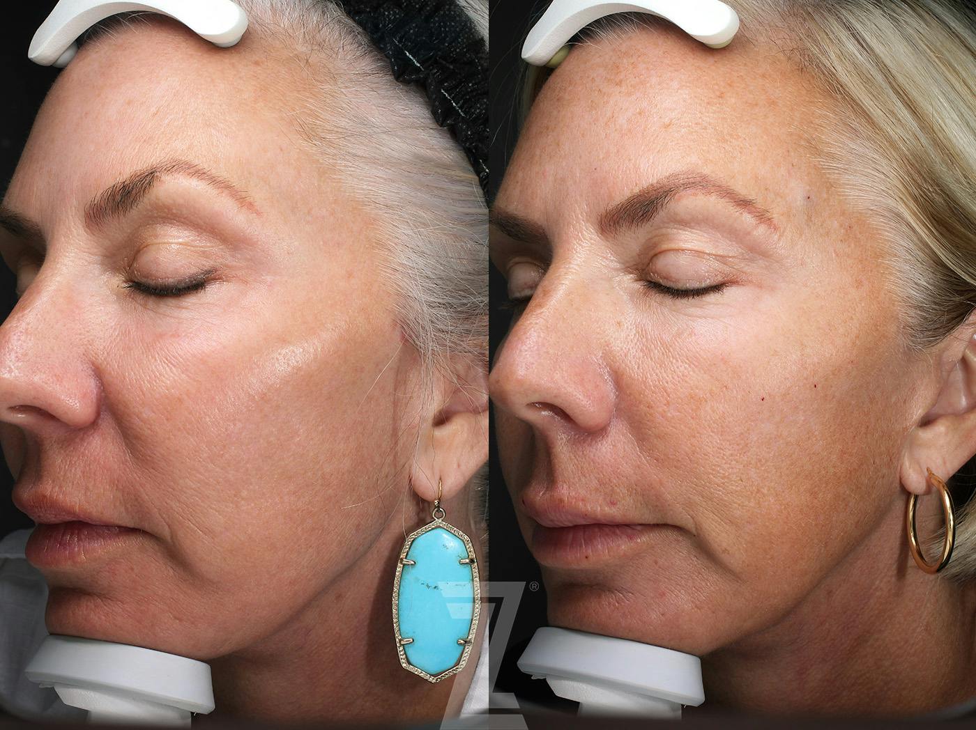 Profound® RF Microneedling Before & After Gallery - Patient 365285 - Image 3