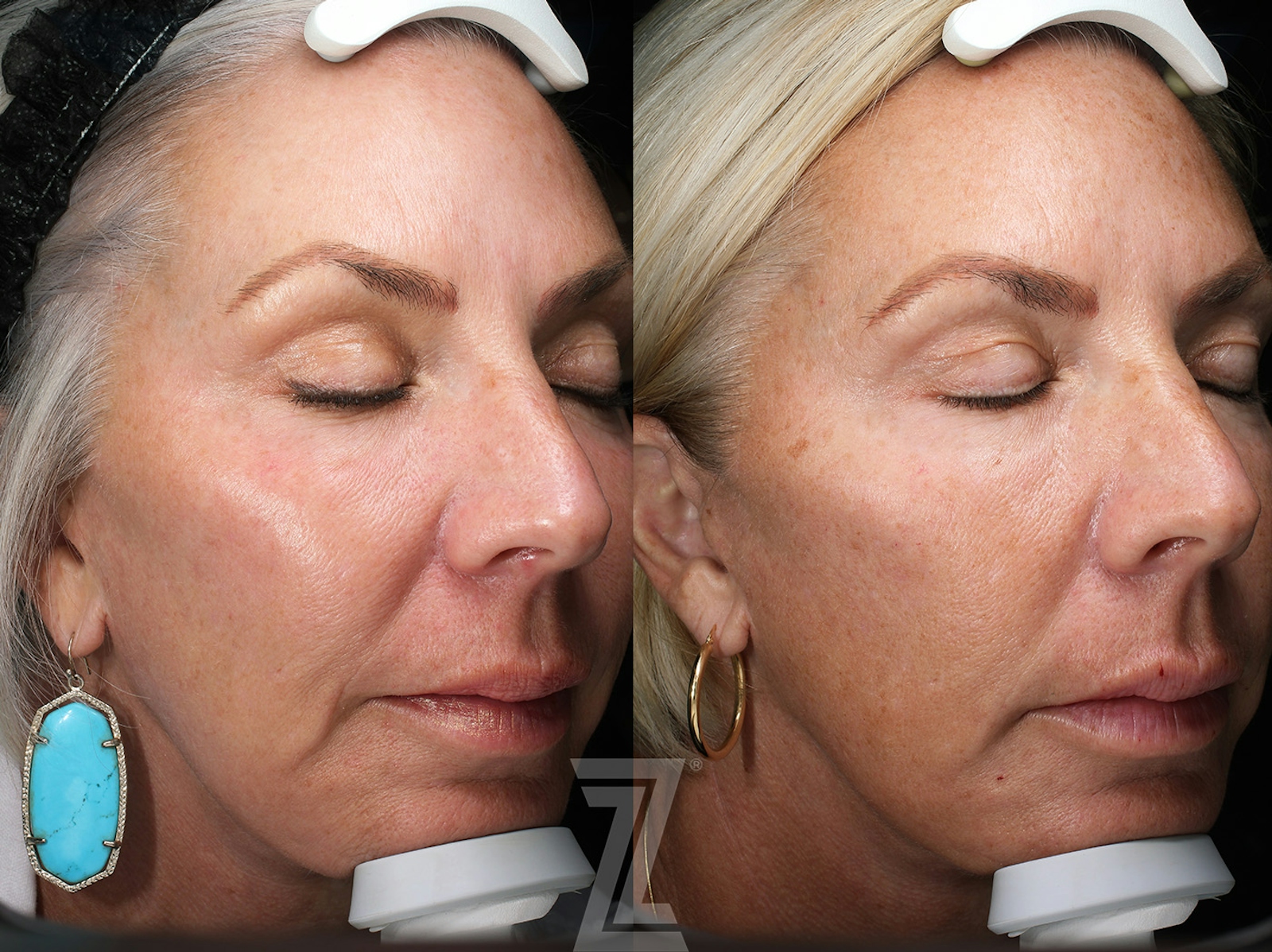 Austin SkinPen Microneedling Before & After Gallery - Patient 362150 - Image 2 - The Piazza Center
