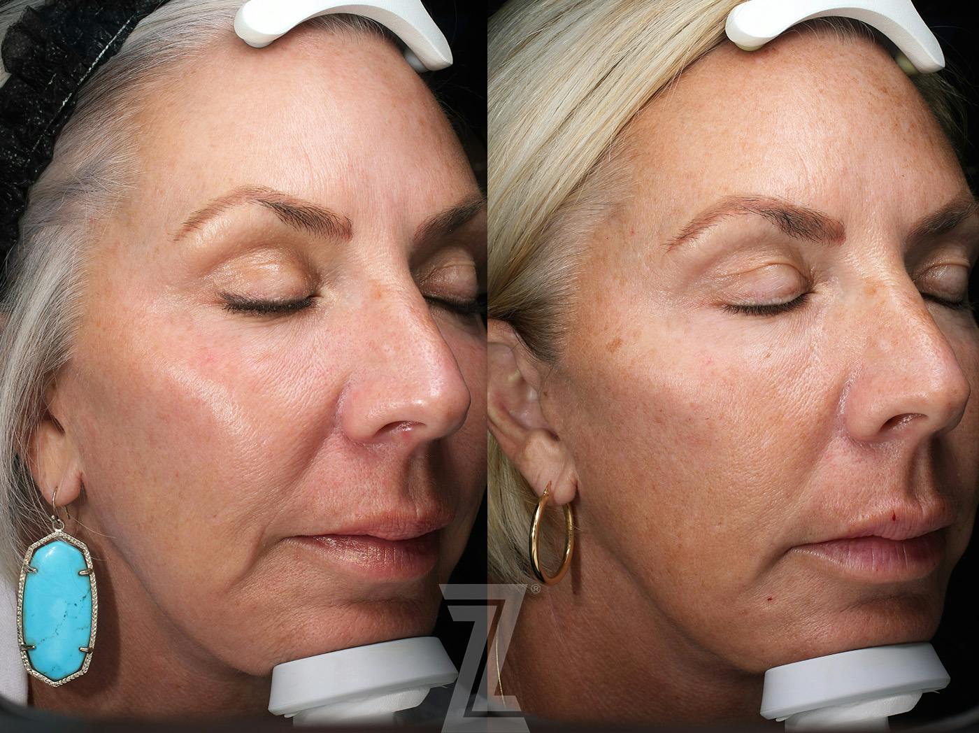 Profound® RF Microneedling Before & After Gallery - Patient 365285 - Image 2