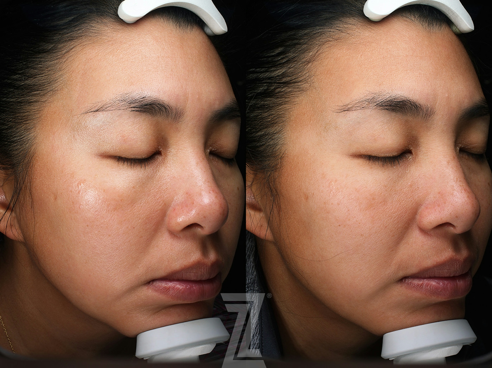 Austin Moxi Before & After Gallery - Patient 270984 - Image 1 - The Piazza Center