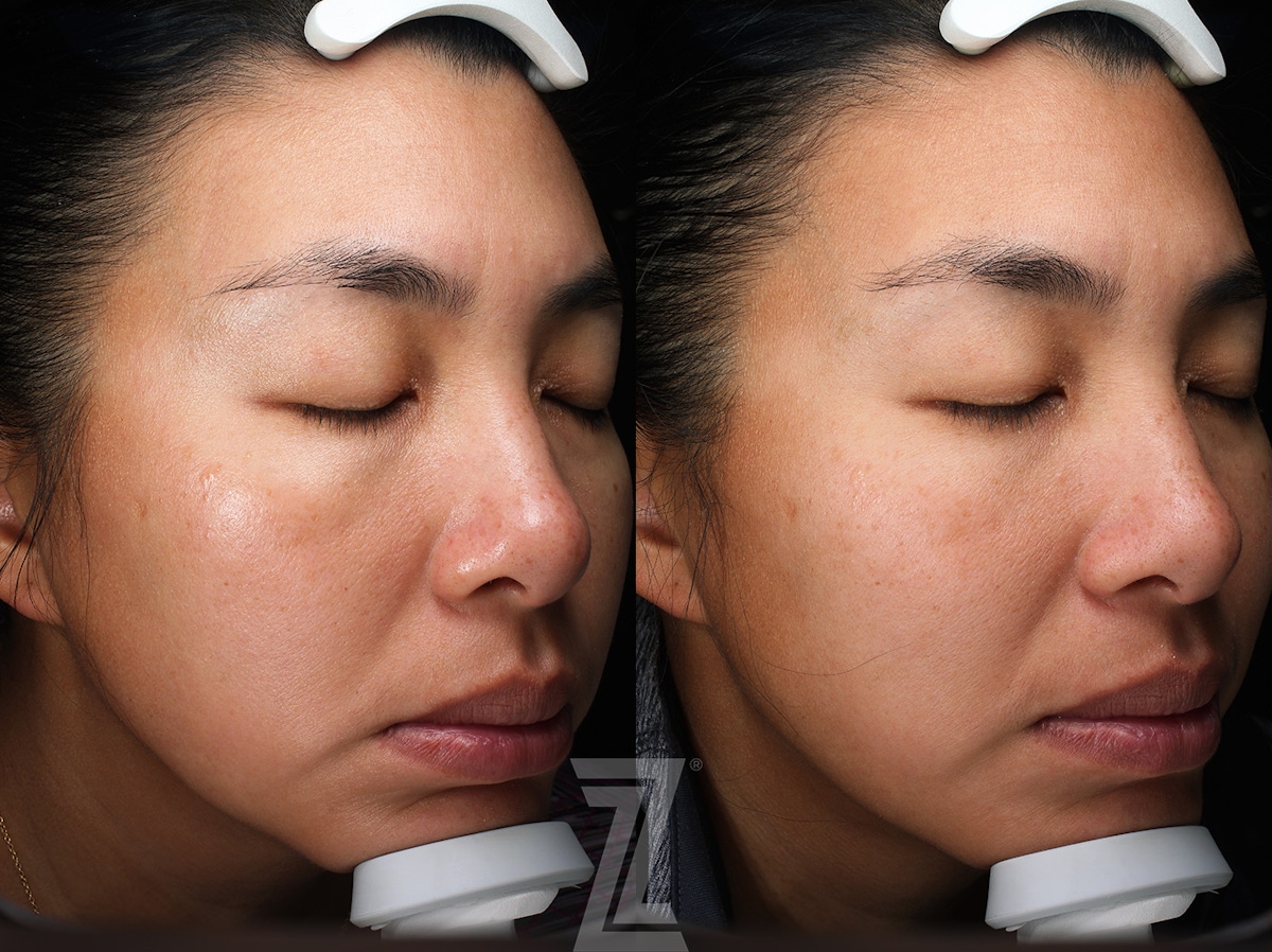 Austin Moxi Before & After Gallery - Patient 270984 - Image 1 - The Piazza Center