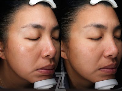 Austin Moxi Before & After Gallery - Patient 270984 - Image 1 - The Piazza Center