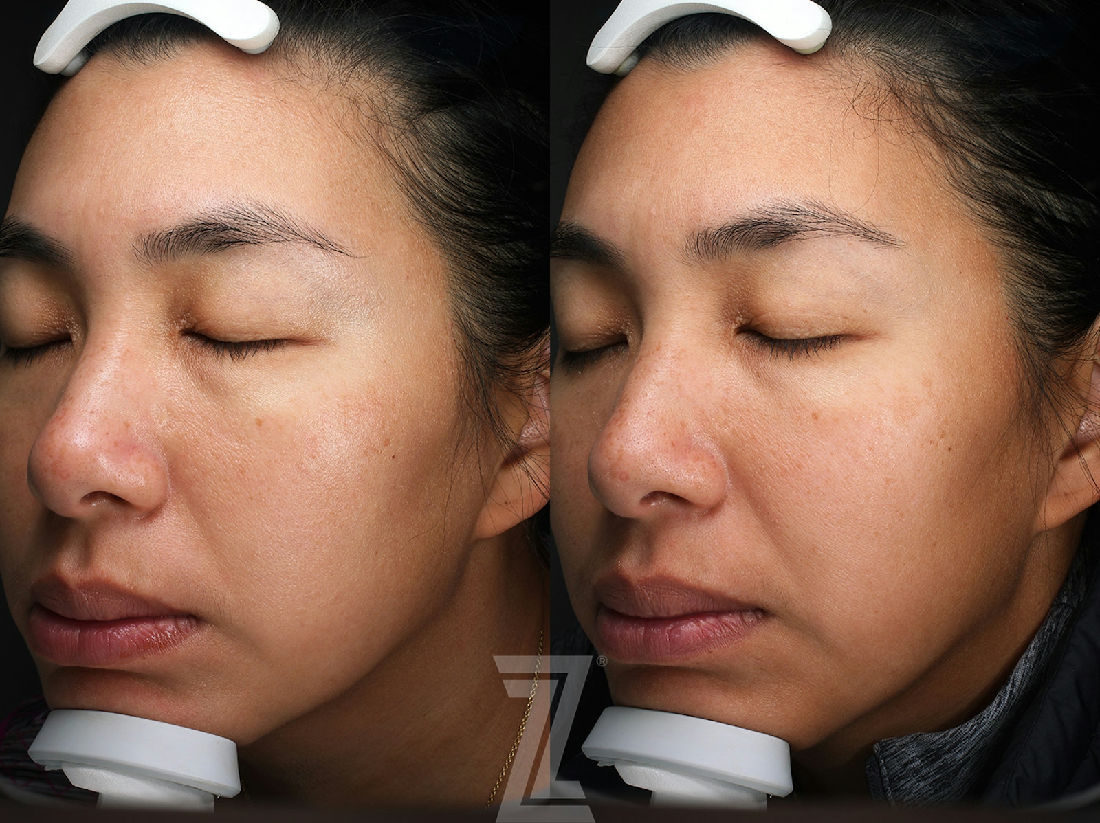 Austin Moxi Before & After Gallery - Patient 270984 - Image 2 - The Piazza Center
