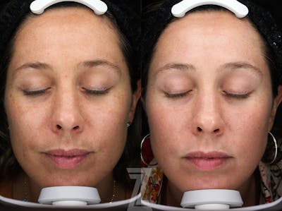 Austin Moxi Before & After Gallery - Patient 143176 - Image 1 - The Piazza Center