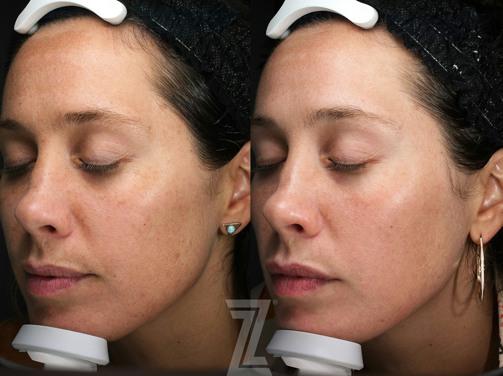 Austin Moxi Before & After Gallery - Patient 143176 - Image 3 - The Piazza Center