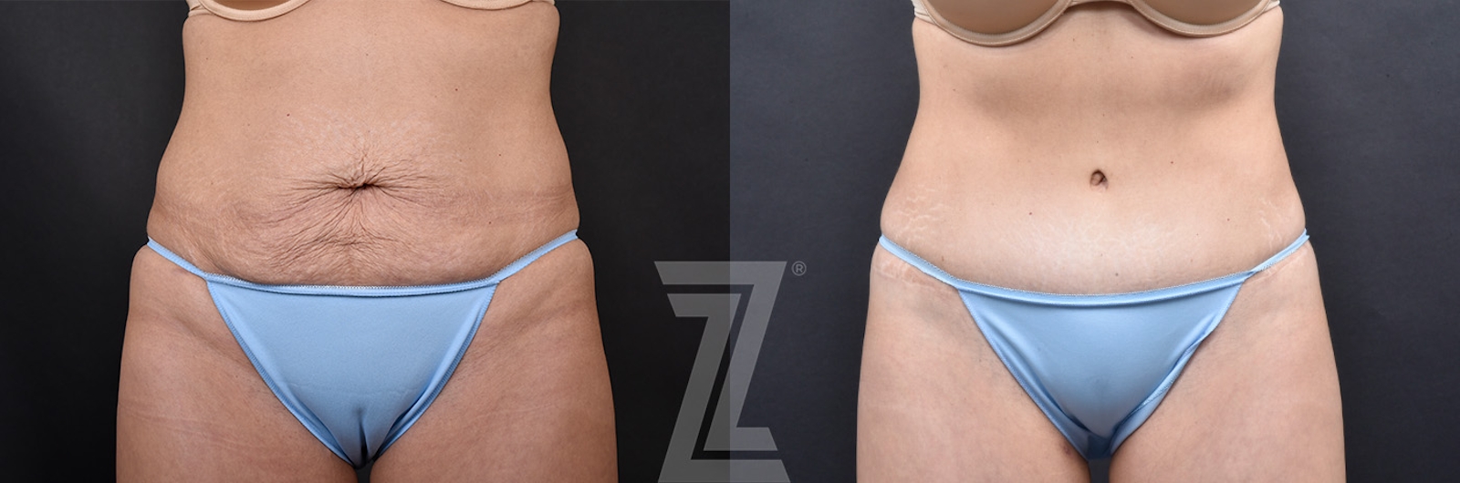 Austin Tummy Tuck Before & After Gallery - Patient 856586 - Image 1 - The Piazza Center