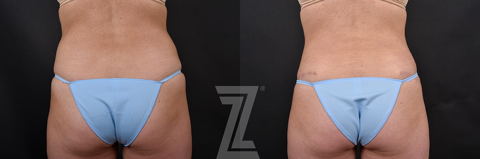 Austin Tummy Tuck Before & After Gallery - Patient 856586 - Image 2 - The Piazza Center