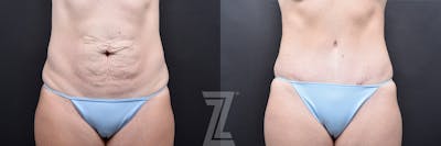 Austin Tummy Tuck Before & After Gallery - Patient 139211 - Image 1 - The Piazza Center