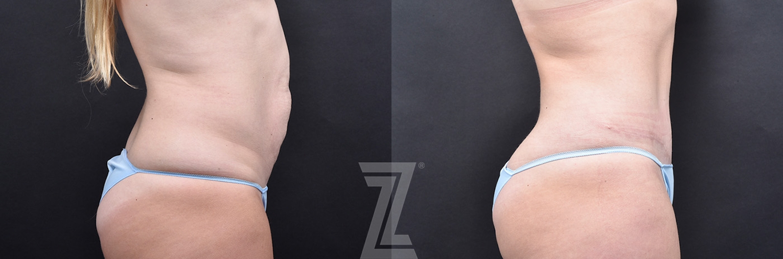 Austin Tummy Tuck Before & After Gallery - Patient 139211 - Image 2 - The Piazza Center
