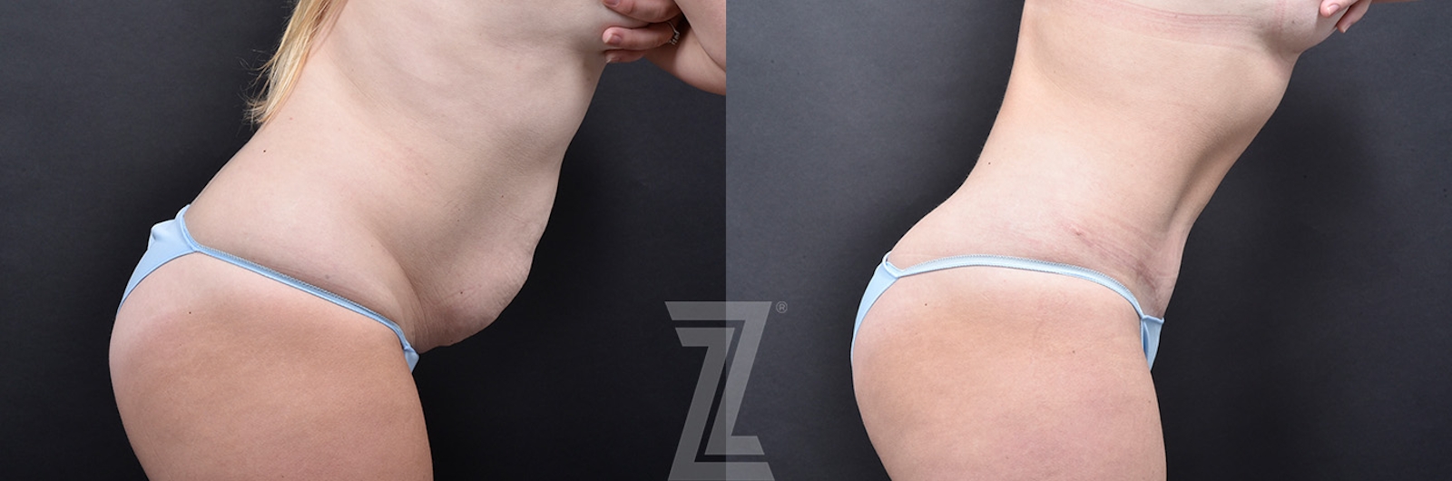 Austin Tummy Tuck Before & After Gallery - Patient 139211 - Image 3 - The Piazza Center