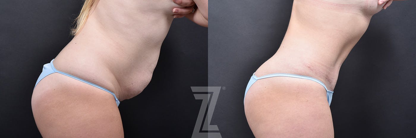 Tummy Tuck Before & After Gallery - Patient 830228 - Image 3