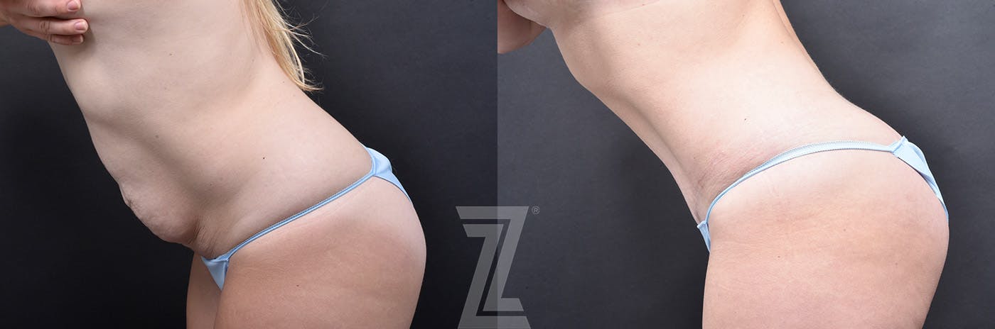 Tummy Tuck Before & After Gallery - Patient 830228 - Image 5