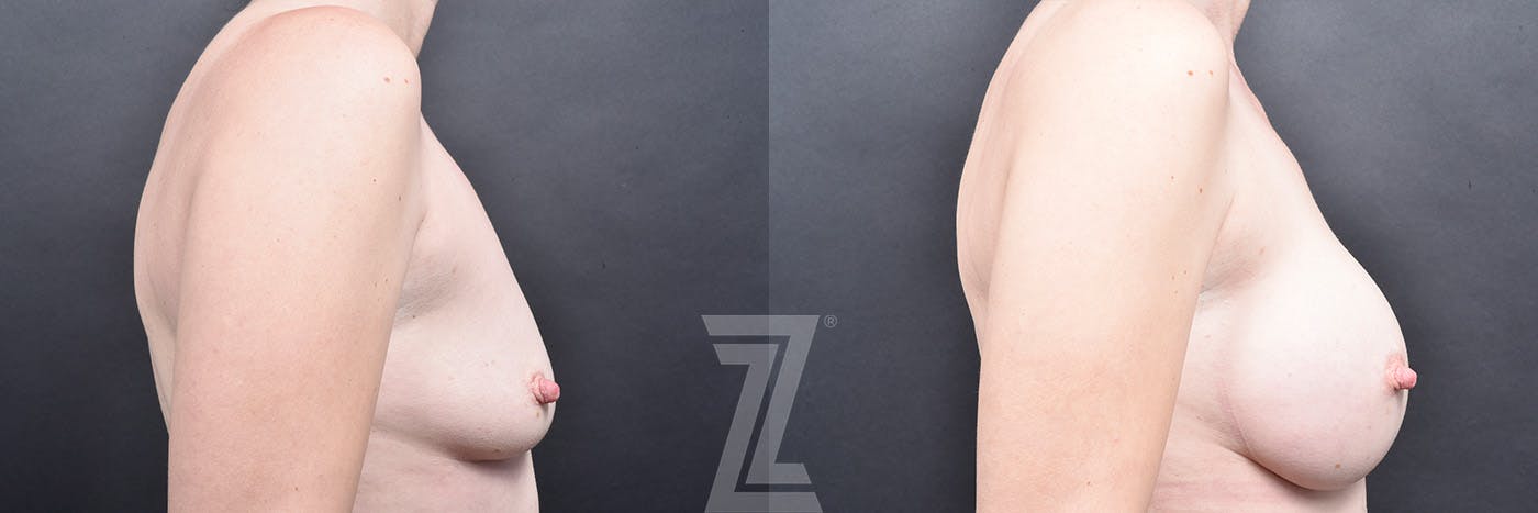 Breast Augmentation Before & After Gallery - Patient 968759 - Image 3