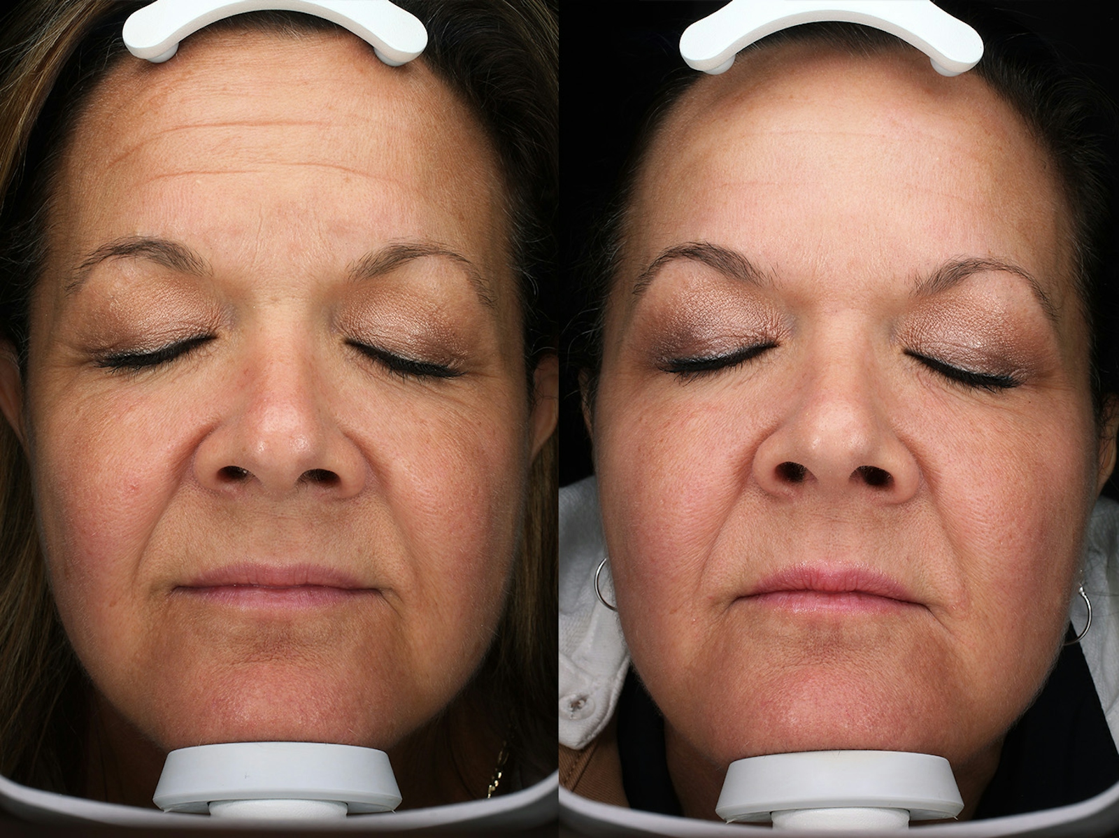 Austin Moxi Before & After Gallery - Patient 278653 - Image 1 - The Piazza Center