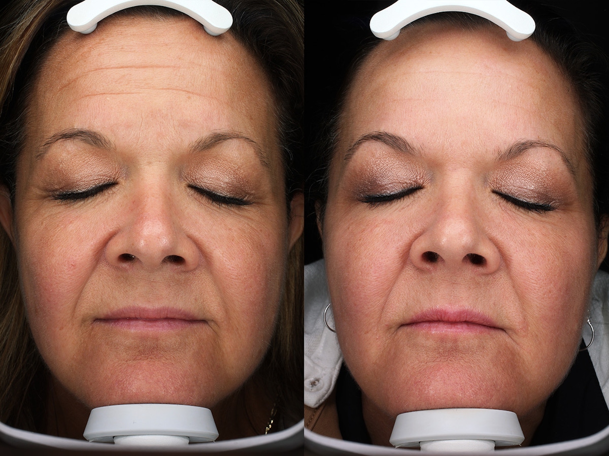 Austin Moxi Before & After Gallery - Patient 278653 - Image 1 - The Piazza Center
