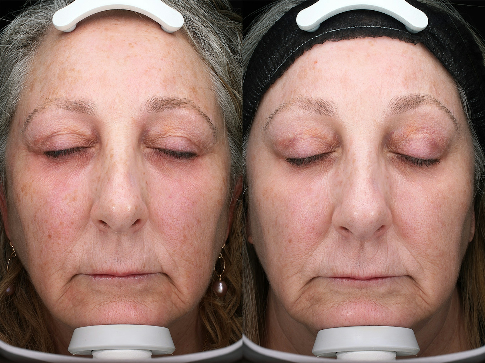 Austin Moxi Before & After Gallery - Patient 200681 - Image 1 - The Piazza Center