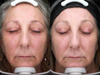 Austin Moxi Before & After Gallery - Patient 200681 - Image 1 - The Piazza Center