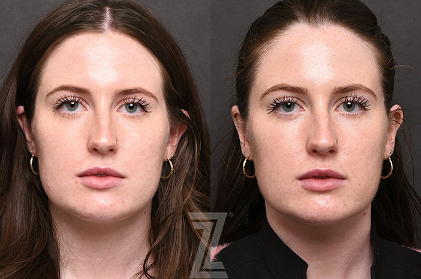 Austin Chemical Peel Before & After Gallery - Patient 207164 - Image 1 - The Piazza Center