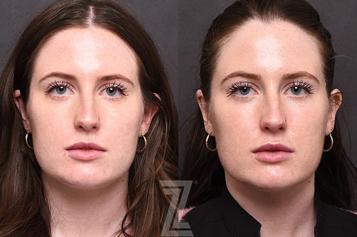 Chemical Peel Before & After Gallery - Patient 207164 - Image 1