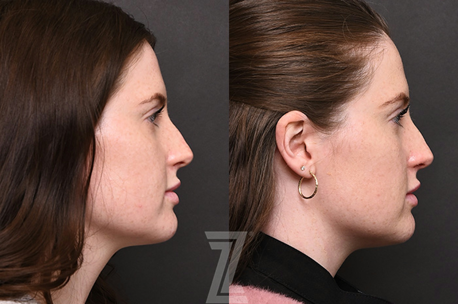 Austin Chemical Peel Before & After Gallery - Patient 207164 - Image 3 - The Piazza Center