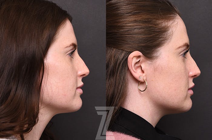 Chemical Peel Before & After Gallery - Patient 207164 - Image 3