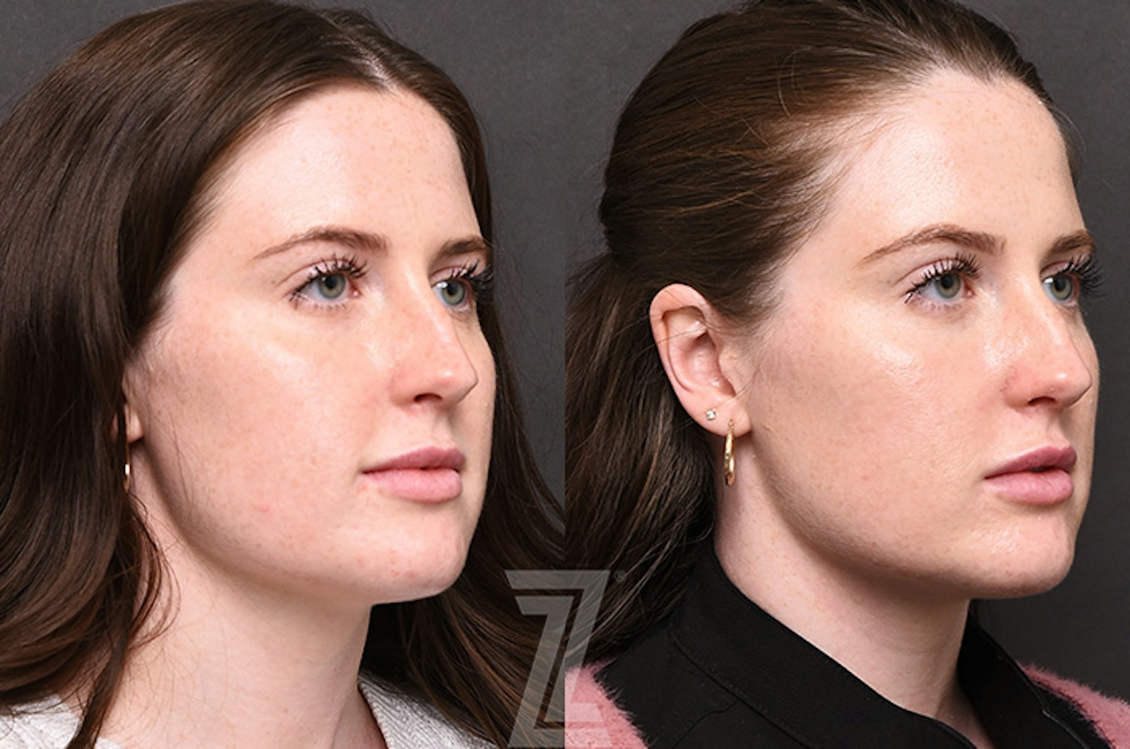 Austin Chemical Peel Before & After Gallery - Patient 207164 - Image 2 - The Piazza Center