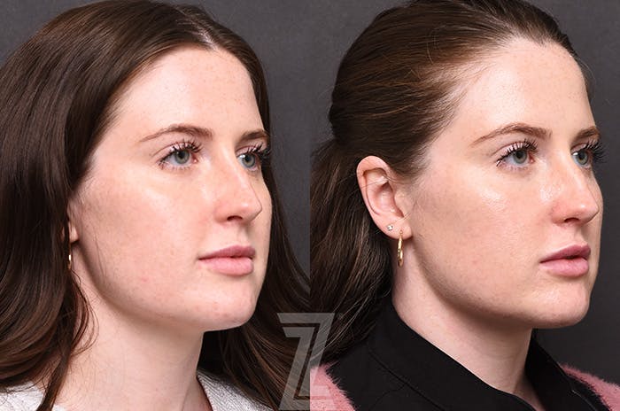 Chemical Peel Before & After Gallery - Patient 207164 - Image 2