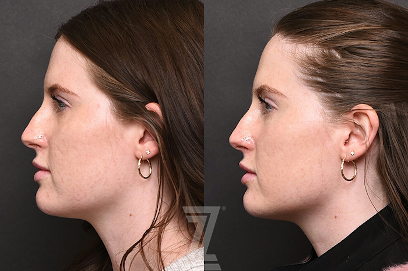 Austin Chemical Peel Before & After Gallery - Patient 207164 - Image 5 - The Piazza Center
