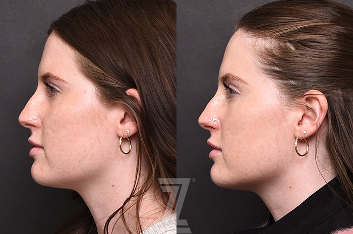 Chemical Peel Before & After Gallery - Patient 207164 - Image 5