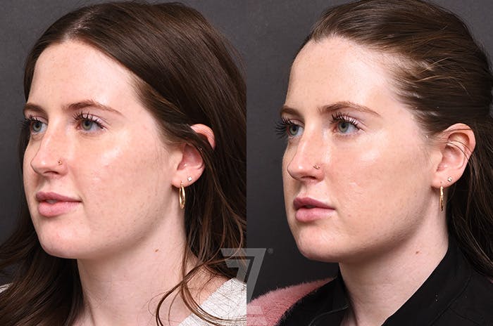 Chemical Peel Before & After Gallery - Patient 207164 - Image 4
