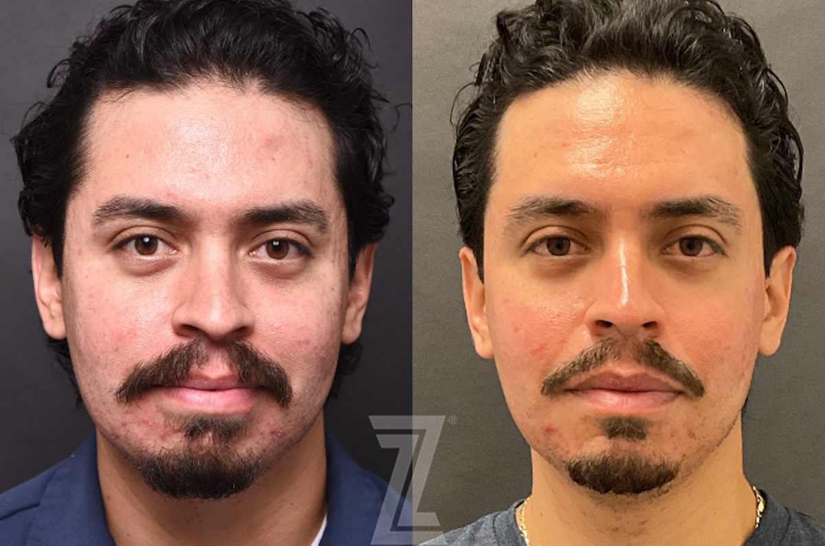 Austin Clear Skin Protocol Before & After Gallery - Patient 279974 - Image 1 - The Piazza Center