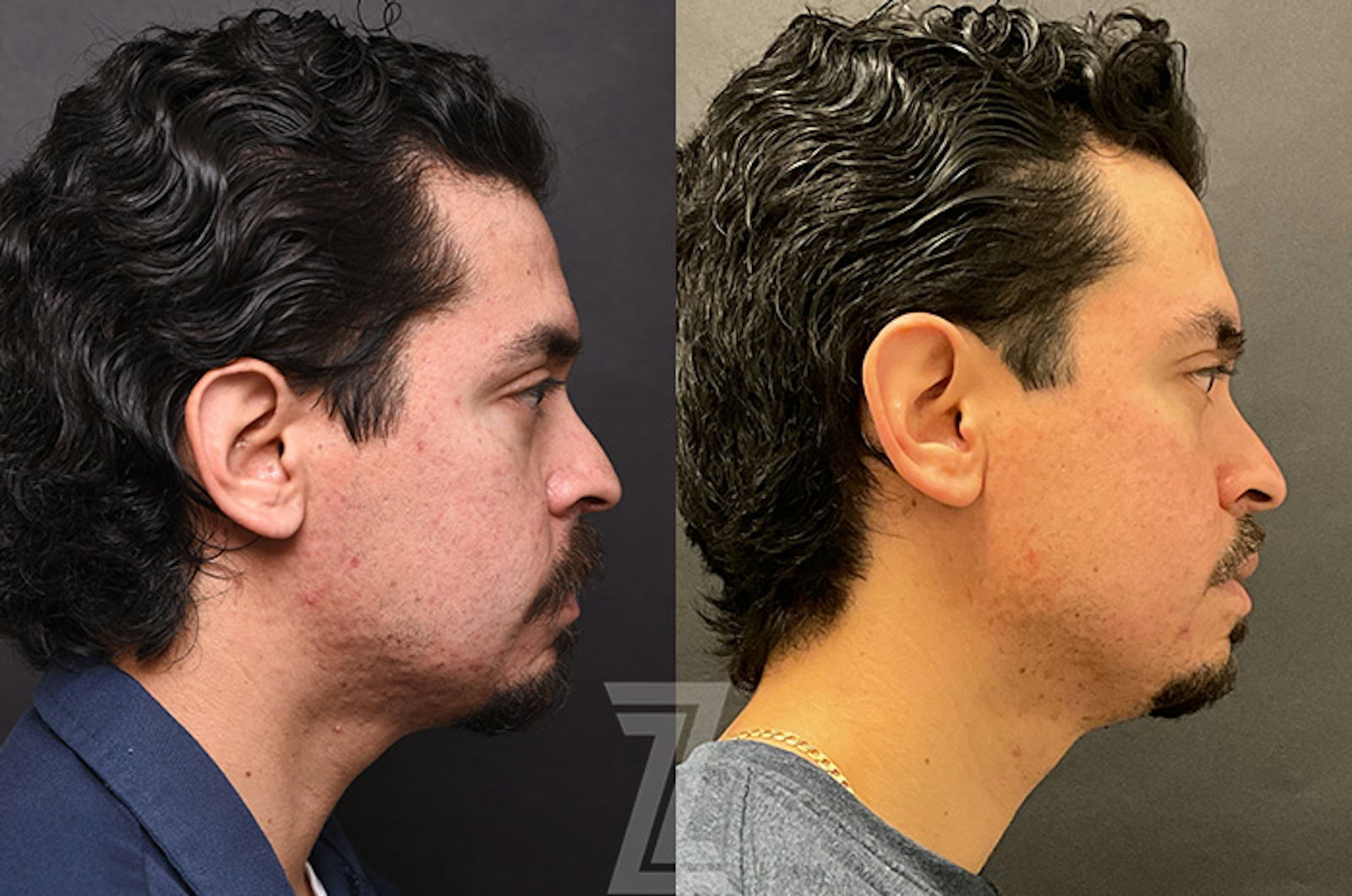 Austin Clear Skin Protocol Before & After Gallery - Patient 279974 - Image 3 - The Piazza Center