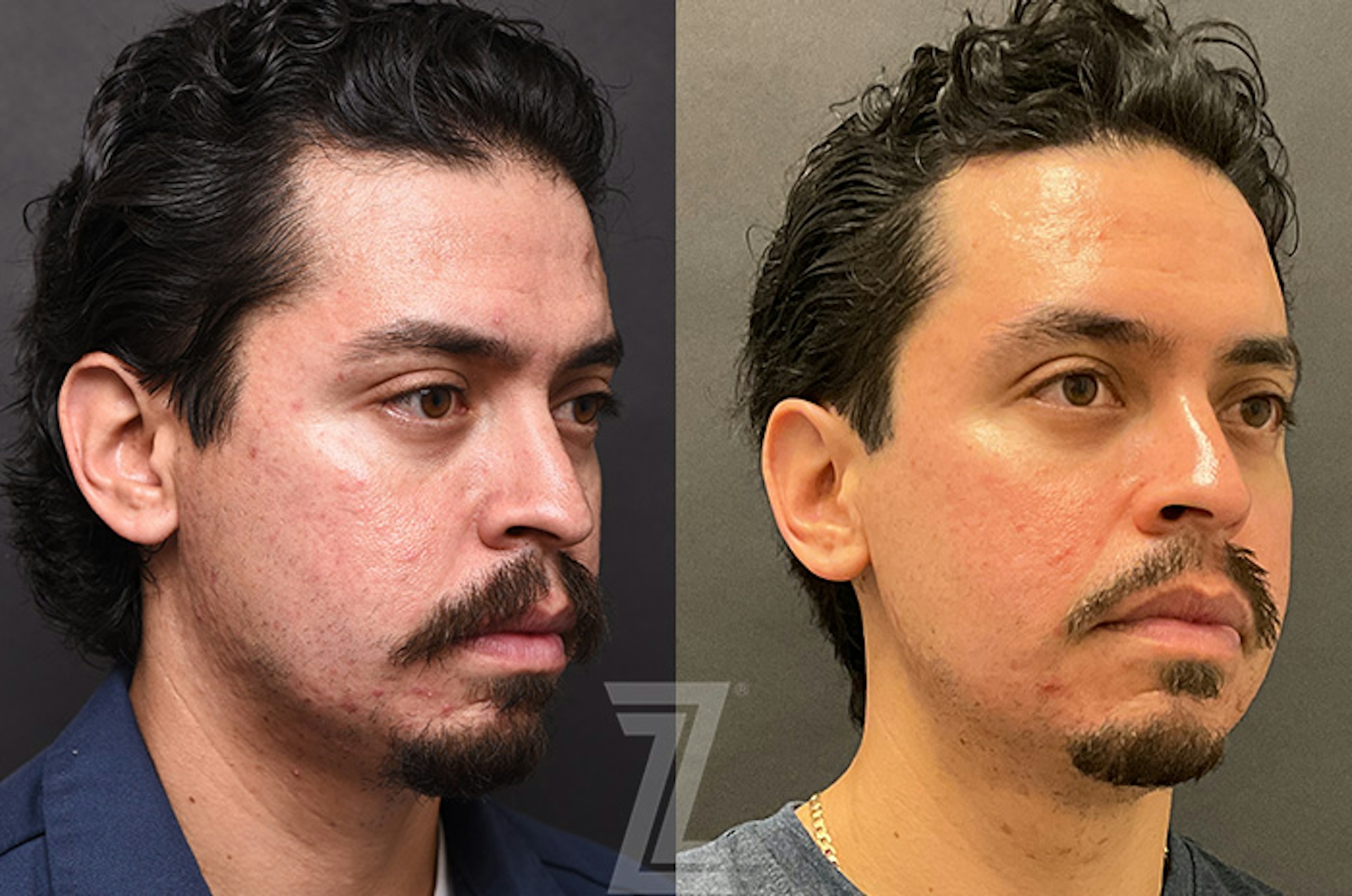 Austin Clear Skin Protocol Before & After Gallery - Patient 279974 - Image 2 - The Piazza Center