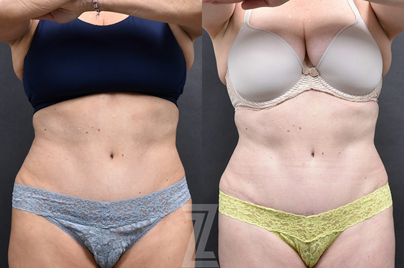 Austin Emsulpt Neo® Before & After Gallery - Patient 126155 - Image 1 - The Piazza Center