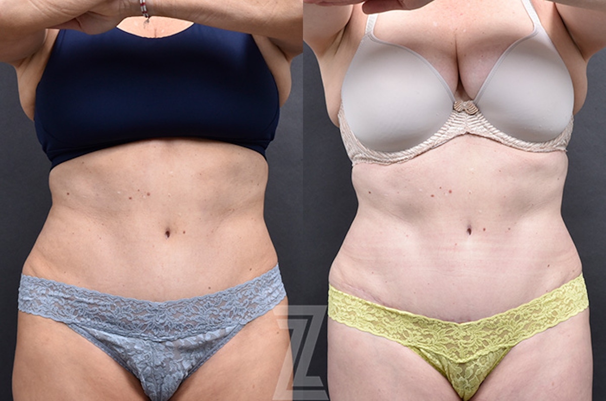 Austin Emsulpt Neo® Before & After Gallery - Patient 126155 - Image 1 - The Piazza Center