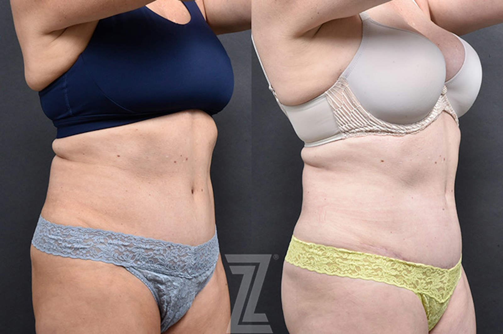 Austin Emsulpt Neo® Before & After Gallery - Patient 126155 - Image 2 - The Piazza Center