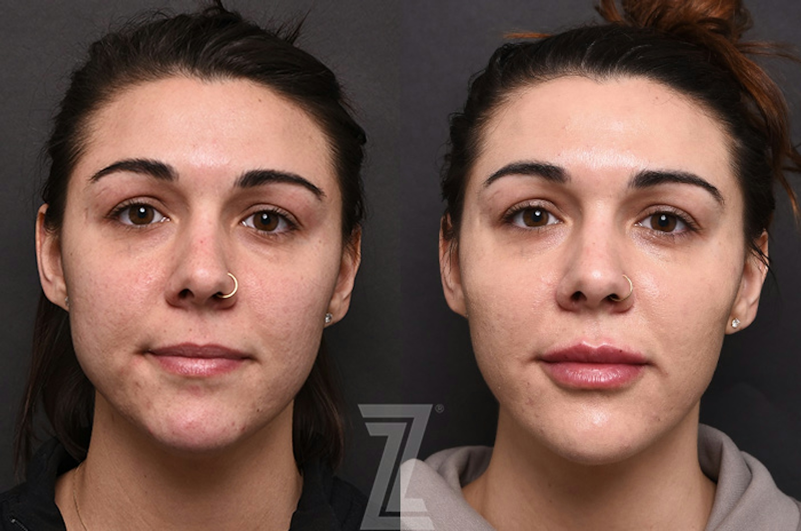 Austin Facial Rejuvenation Before & After Gallery - Patient 225278 - Image 1 - The Piazza Center