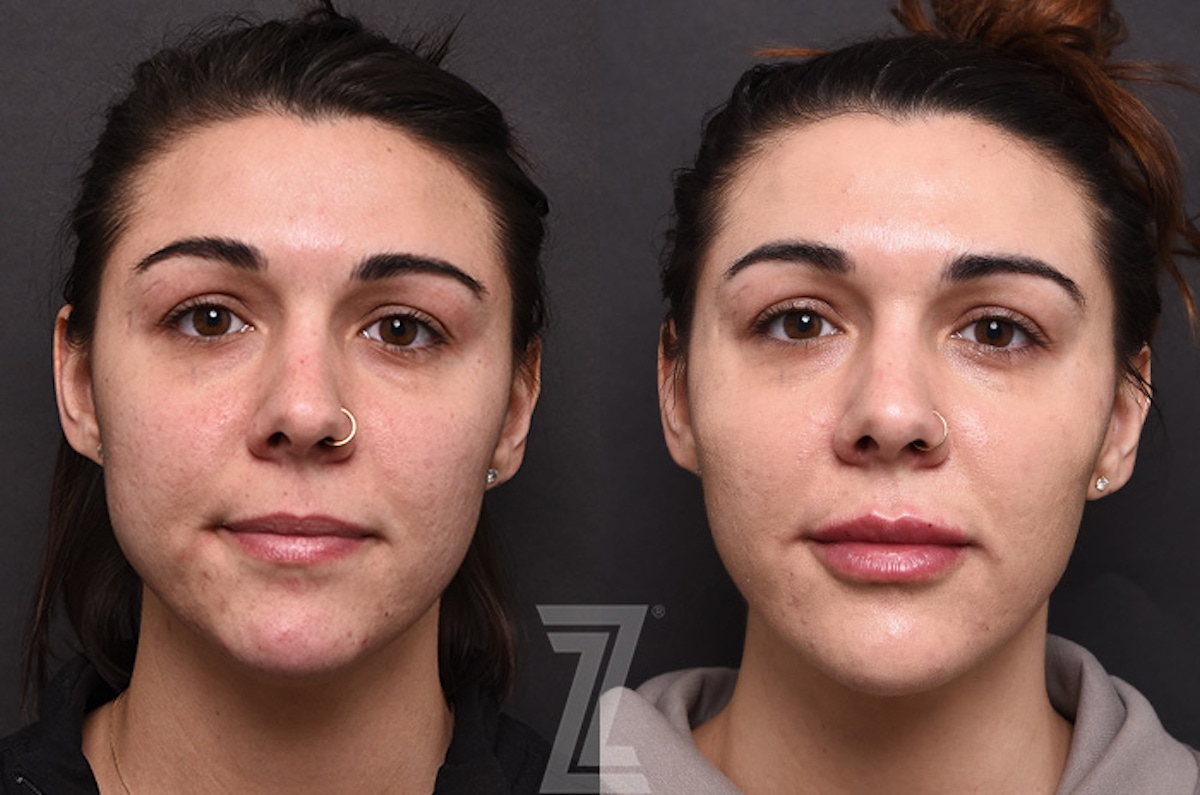 Austin Facial Rejuvenation Before & After Gallery - Patient 238339 - Image 1 - The Piazza Center