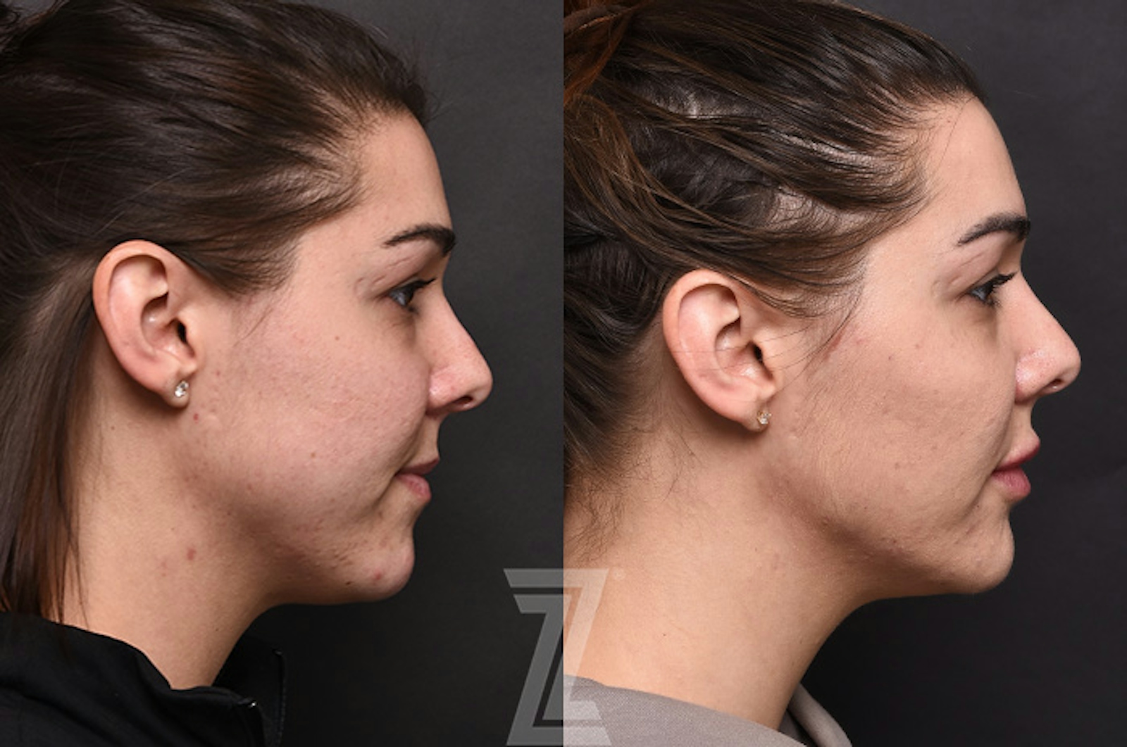 Austin Facial Rejuvenation Before & After Gallery - Patient 225278 - Image 3 - The Piazza Center