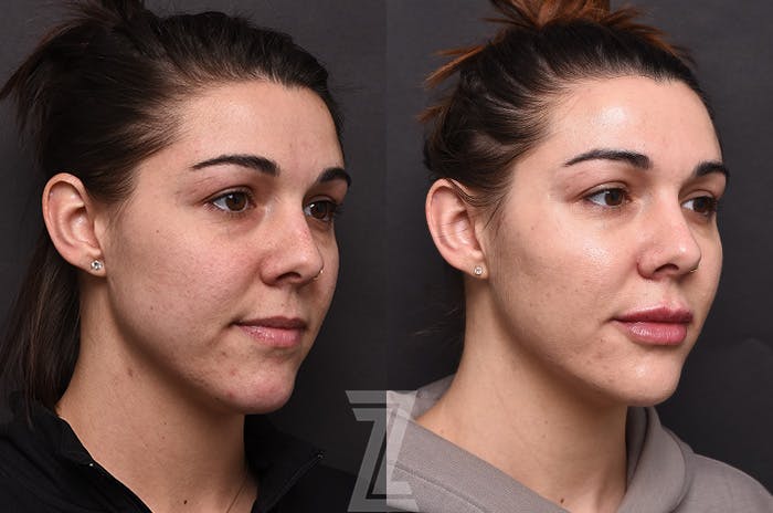Facial Rejuvenation Before & After Gallery - Patient 225278 - Image 2