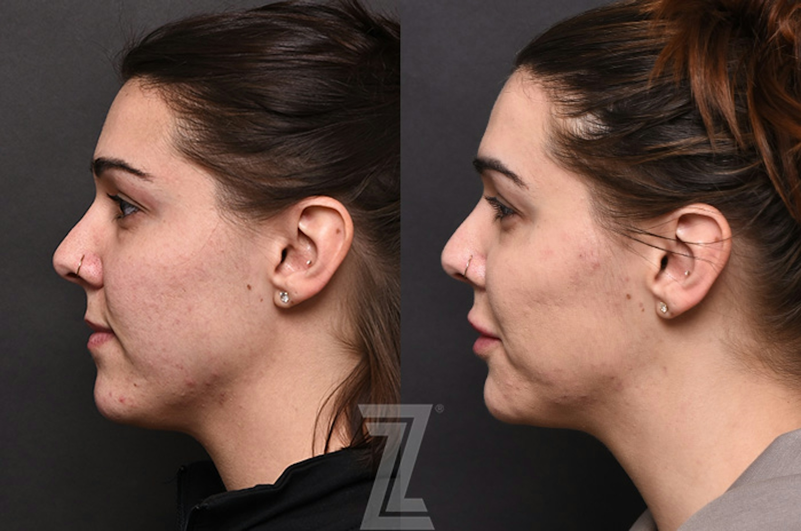 Austin Facial Rejuvenation Before & After Gallery - Patient 225278 - Image 5 - The Piazza Center