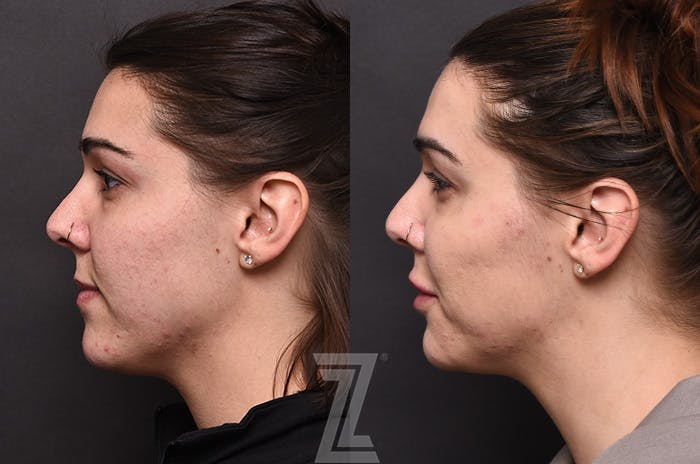 Facial Rejuvenation Before & After Gallery - Patient 225278 - Image 5
