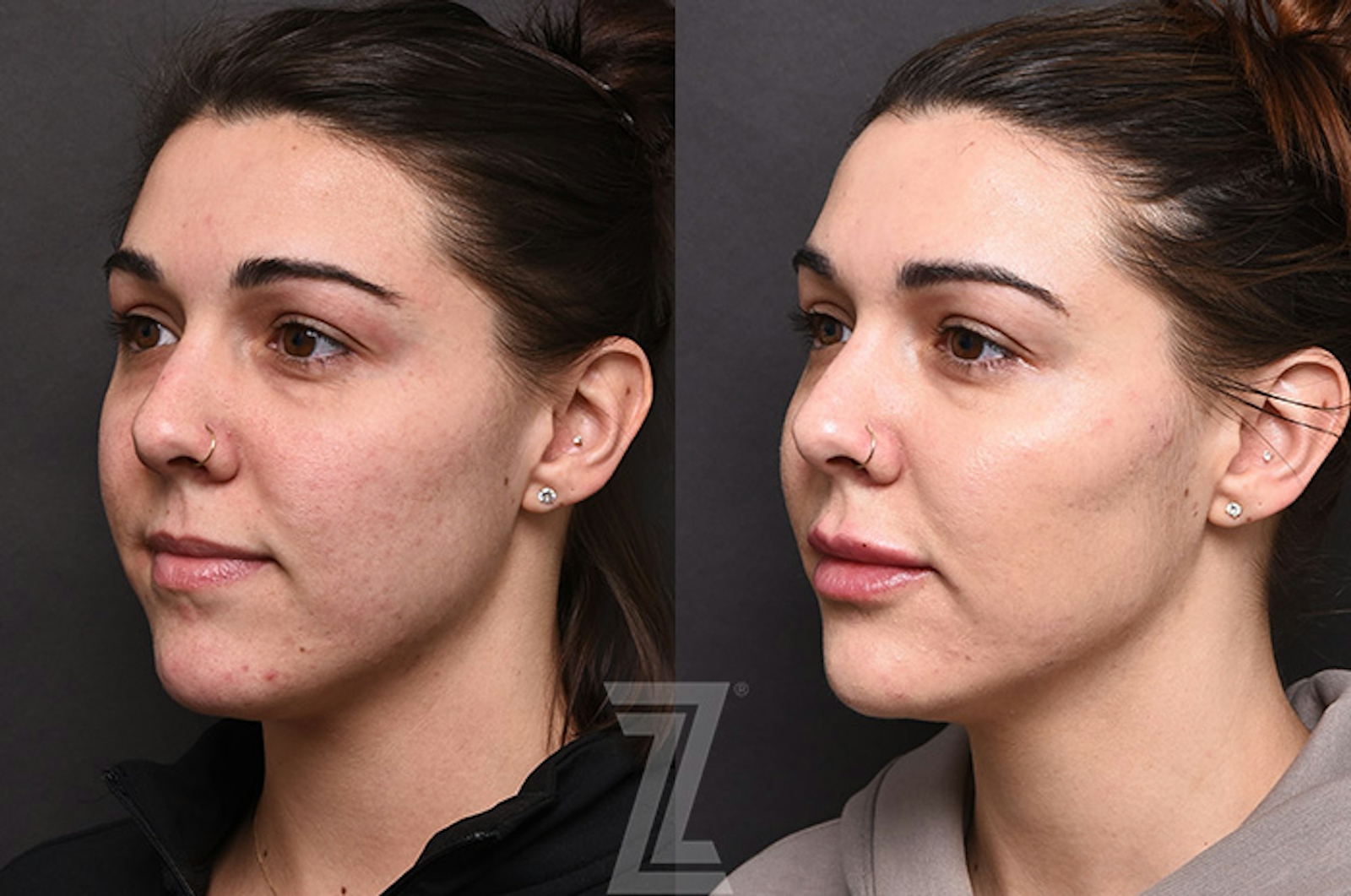 Austin Facial Rejuvenation Before & After Gallery - Patient 225278 - Image 4 - The Piazza Center