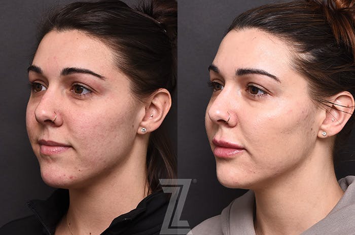 Facial Rejuvenation Before & After Gallery - Patient 225278 - Image 4