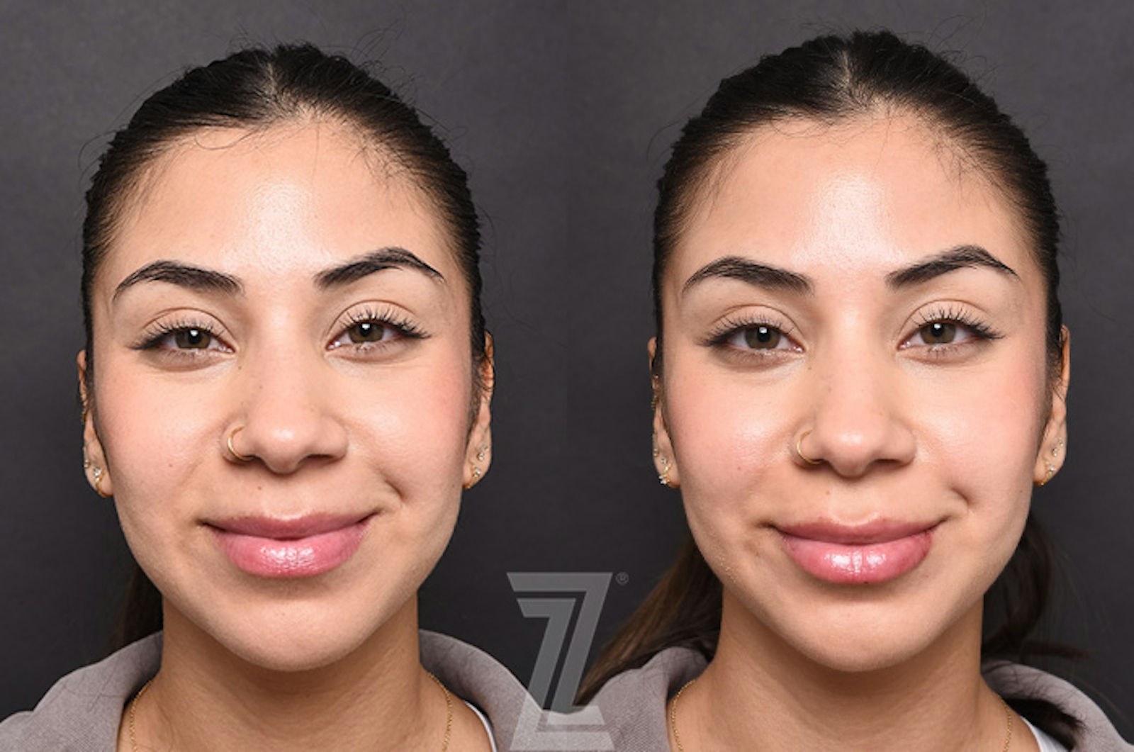 Austin Injectable Fillers Before & After Gallery - Patient 353710 - Image 1 - The Piazza Center