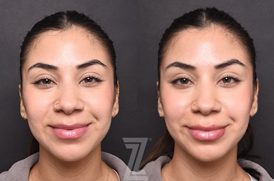 Injectable Fillers Before & After Gallery - Patient 353710 - Image 1