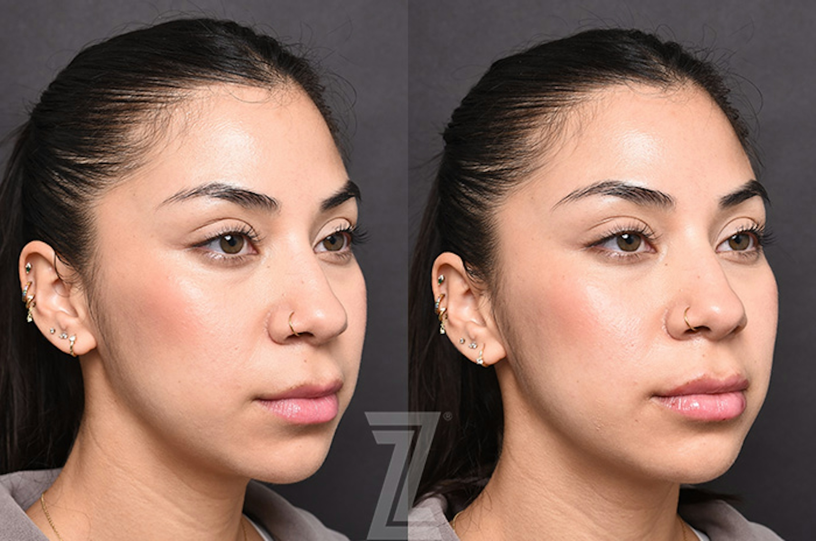 Austin Injectable Fillers Before & After Gallery - Patient 353710 - Image 2 - The Piazza Center