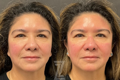 HydraFacial™ Before & After Gallery - Patient 384379 - Image 1