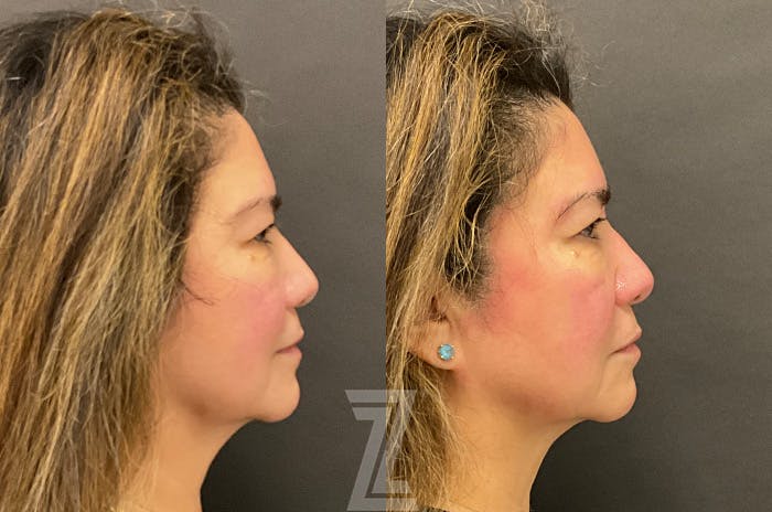 HydraFacial™ Before & After Gallery - Patient 384379 - Image 3