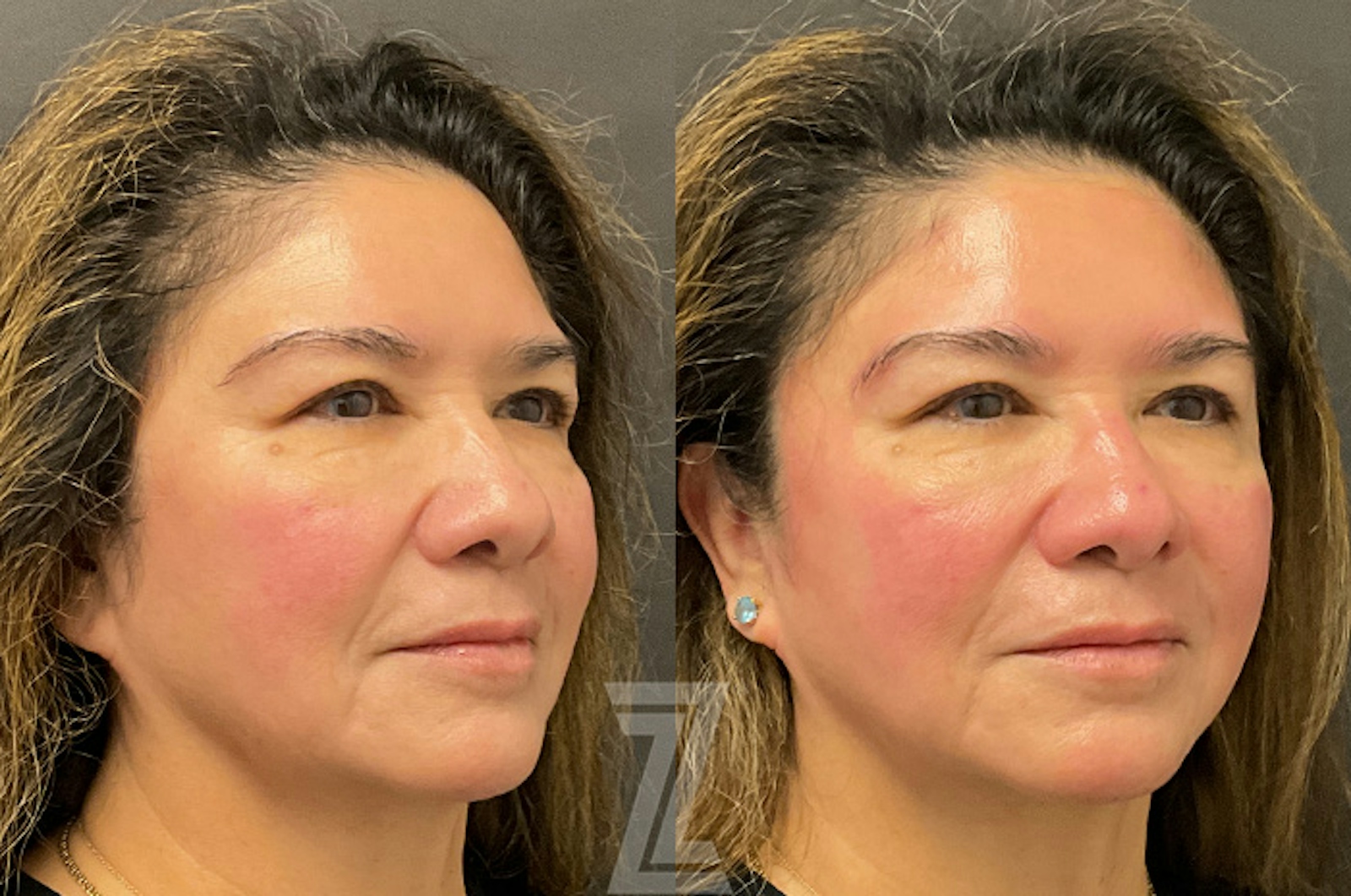Austin HydraFacial™ Before & After Gallery - Patient 384379 - Image 2 - The Piazza Center